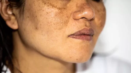 pigmentation